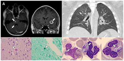 Case Report: Immune Dysregulation Due to Toxoplasma gondii Reactivation After Allogeneic Hematopoietic Cell Transplant